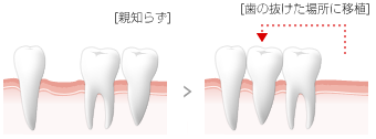 歯の移植